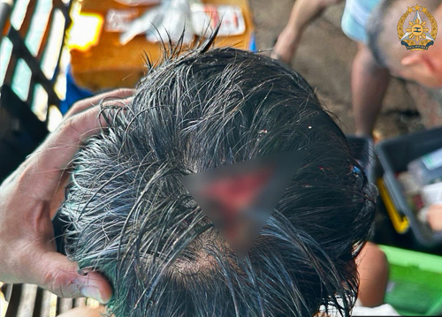 Sugatan ang sundalo ng Philippine Navy matapos umanong hampasin ng China Coast Guard sa Ayungin Shoal